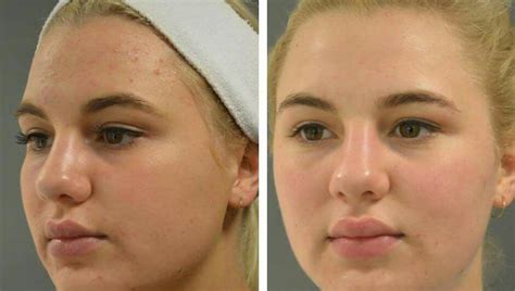Before And 3 Months After The Perfect Peel Delighted Illuminate Skin