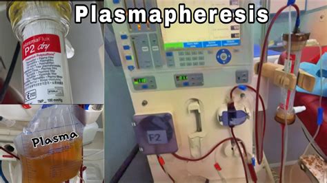 What Is Plasmapheresis Plasma Exchange Plasmapheresis Dialysis