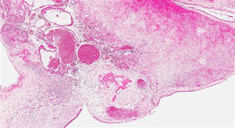 Nasal Polyps Histology