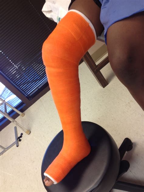 17 Best Images About Leg Casts And Arm Casts After Surgery Or Injury
