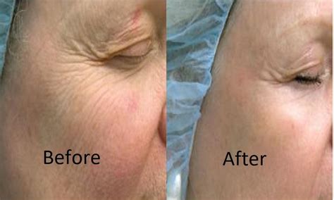 Wrinkle Reduction Laser Skin Resurfacing Anita Dey Md Aesthetics