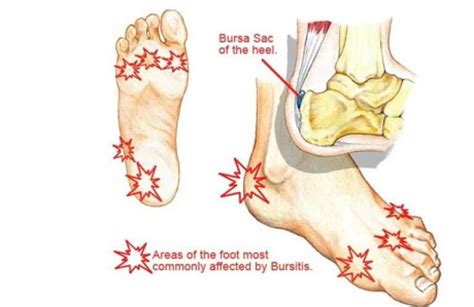 Bursitis Foot Pain Treatment And Recovery Walkjogrun
