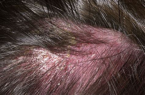 It's not clear what causes cradle cap. Eczema Scalp Pictures - 10 Photos & Images / illnessee.com