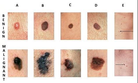 Skin Cancer Symptoms Causes And Treatment