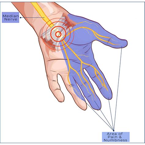 Carpal Tunnel Symptoms And Treatment Spine And Orthopedic Center