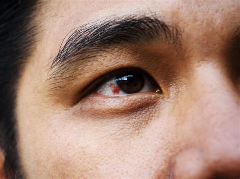 Now i will over analyze everyone who ever says they are fine. Red spot on eye: Causes and treatment