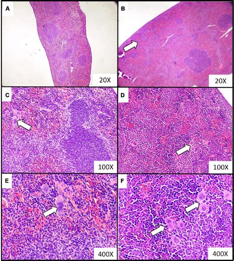 Representative Histopathological Images Of The Extramedullary