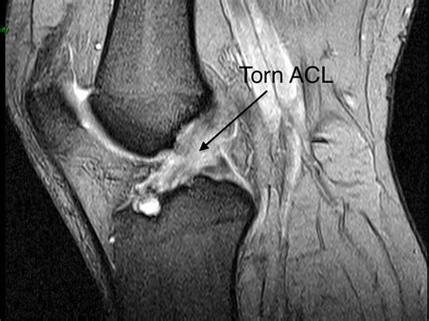 Knee Sports Injury Anterior Cruciate Ligament Acl In Knee Sports