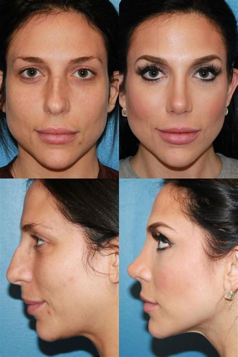 Nose Job Before After App Jaw Dropping Diary Galleria Di Immagini