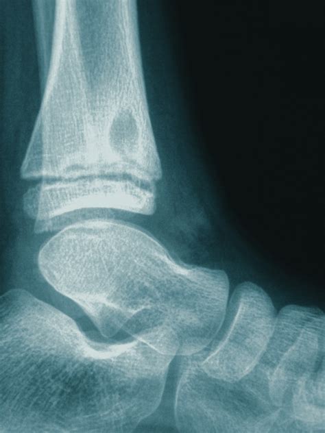 Osteomyelitis Pediatric Pediatrics Orthobullets