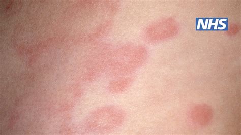 Hives Caused By Stress Or Anxiety