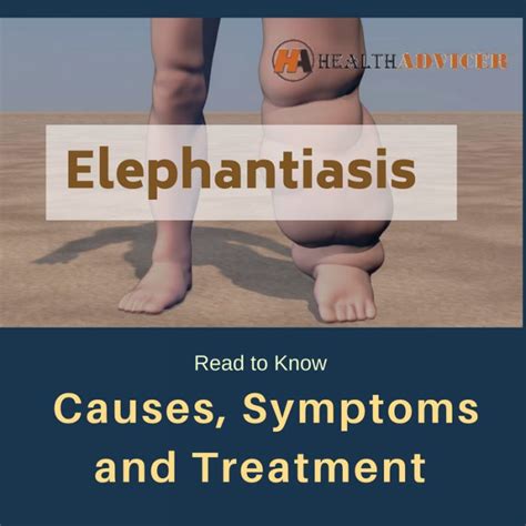 Elephantiasis : Causes, Symptoms, Treatment And Prevention
