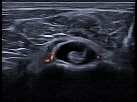 Long Head Of The Biceps Tenosynovitis Ultrasound Cases