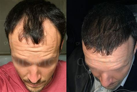 Fue Hair Transplant The Chiswick Hair Clinic