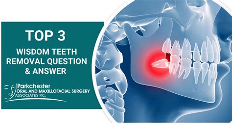 Top 3 Wisdom Teeth Removal Questions To Ask Youtube