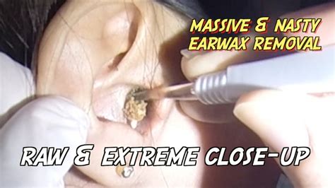 Massive And Nasty Earwax Removal Raw And Extreme Close Up Version Youtube