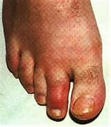Medical Condition Gout Images