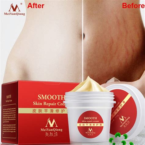 High Quality Smooth Skin Cream For Stretch Marks Scar Removal To