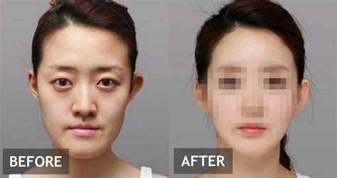 South Korean Eyelid Surgery Korean Styles