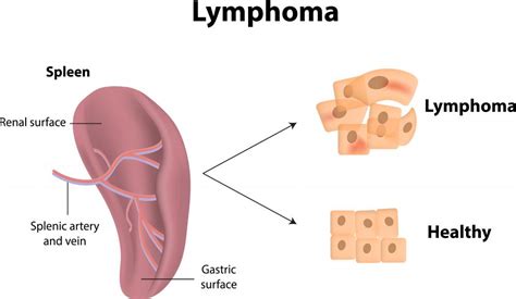 What Are The Different Types Of Lymphoma Of The Spleen