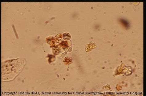 Bilirubin Crystals From The Urinary Sediment Of A Patient With