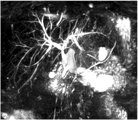 Image Of Mrcp Showing Diffuse Intrahepatic Biliary Strictures Pat 16