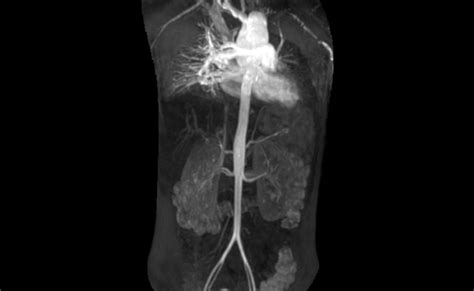 Takayasu Arteritis Efficacy And Safety Of Tocilizumab Vs Placebo