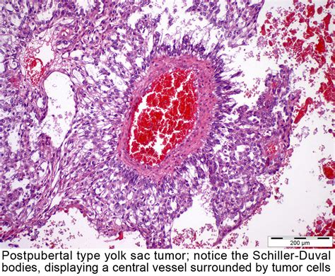 Pathology Outlines Yolk Sac Tumor