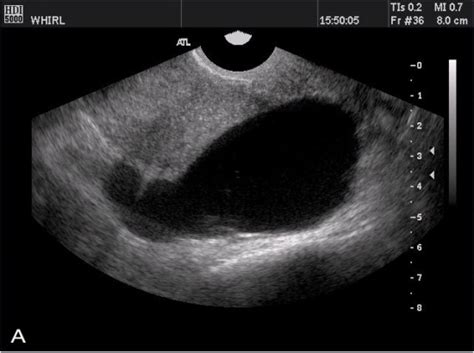 Transvaginal Ultrasonography And Hot Sex Picture