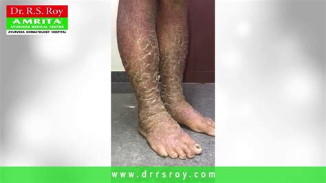 A person with psoriasis could use ayurvedic preparations on their skin. Psoriasis On Legs Before and After Treatment Kochi ...