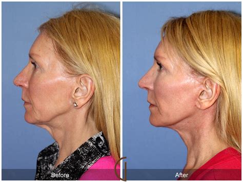 Facelift Fifties Before And After Photos Patient 47 Dr Kevin Sadati