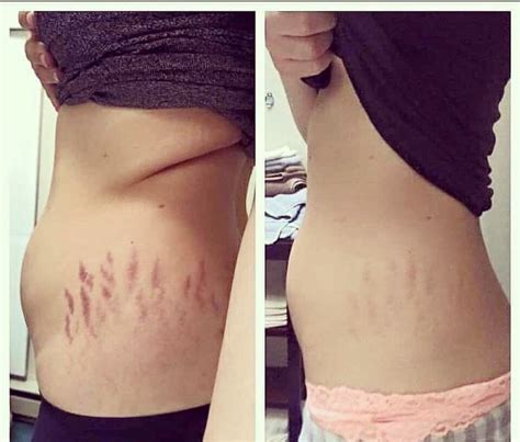 Get Rid Of Those Stretch Marks Now Click Here For The Magic Potion
