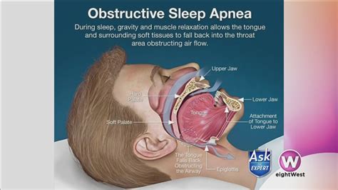 oral appliances may be the answer to sleep apnea