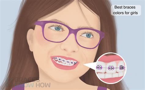 Braces Colors For Girls Top Picks To Brighten Your Smile