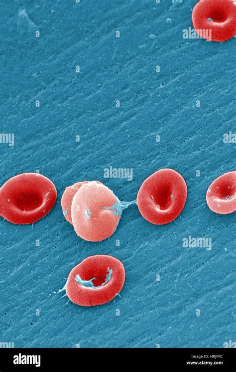 La Anemia De Células Falciformes Los Eritrocitos Humanos Sem Fotografía De Stock Alamy