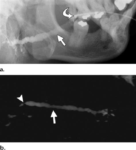 Submandibular Duct Obstruction Secondary To A Distal Stricture Mr