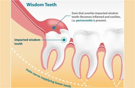 Pericoronitis Wisdom Tooth Removal Aries Oro Facial Dental