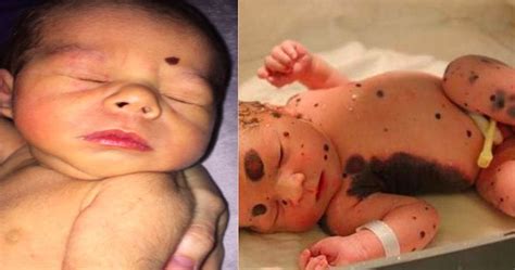 Hal ini dapat terjadi pada si kecil karena kulit sensitifnya sedang meskipun bintik merah pada bayi merupakan hal yang wajar terjadi, namun masih saja banyak orangtua yang khawatir akan hal tersebut. Tanda merah pada bayi baru lahir bisa hilang atau tidak ...