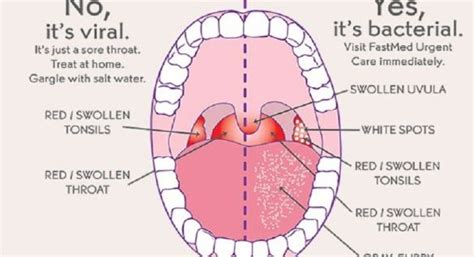 Really Bad Sore Throat Fix How Sore Throat V Alert Vrtl T Tonsil