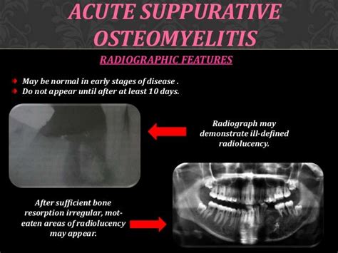 Jaw Bone Infection Symptoms And Osteomyelitis Causes