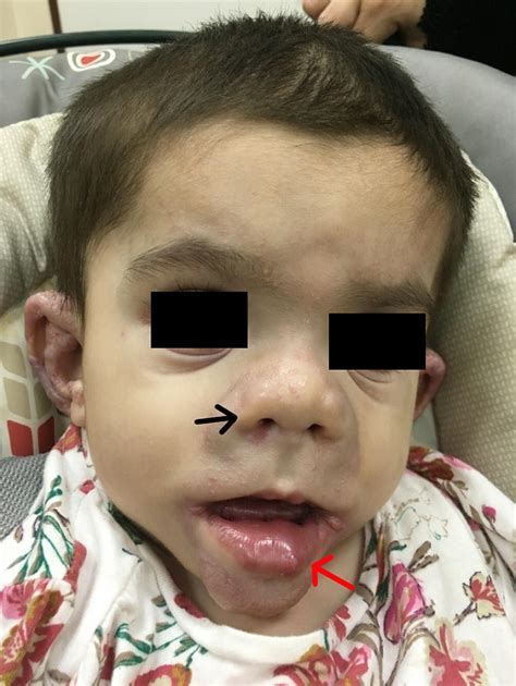 Cureus A Severe Case Of Infantile Systemic Hyalinosis In An Asian