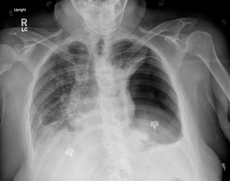 Pneumothorax X Ray Findings
