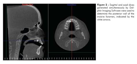 Foramen ovale is a foramen in the greater wing of sphenoid bone, and it gets its name from the latin word ovale, which means oval window. Tomographic mapping of the hard palate and overlying mucosa