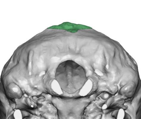 Occipital Knob Reduction 3d Ct Scan S Below View Dr Barry Eppley