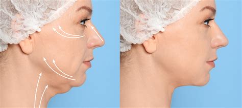 Coolsculpting Double Chin Fat Visage Dermatology And Aesthetic Center