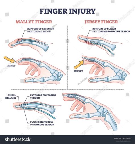 Finger Injury Types Common Hand Impact Stock Vector Royalty Free