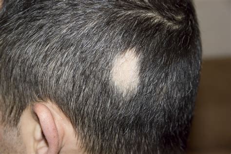 Alopecia areata qué es síntomas causas y tratamiento