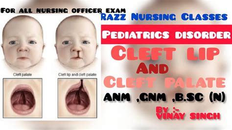 Cleft Lip Or Cleft Palate Free Nursing Classes Razz Nursing Classes Pediatric Youtube