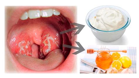 Amígdalas Grandes O Que Pode Ser
