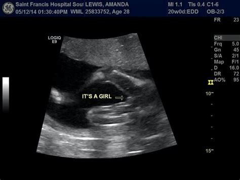 Ultrasound 20 Weeks Its A Girl Baby Pinterest A